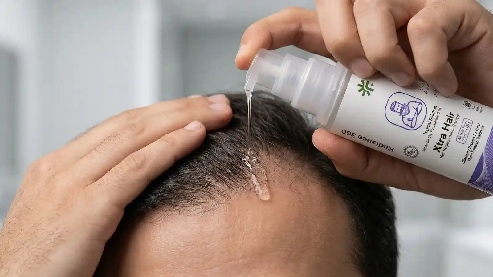 Minoxidil for a Receding Hairline: Results, Timeline, and What to Realistically Expect