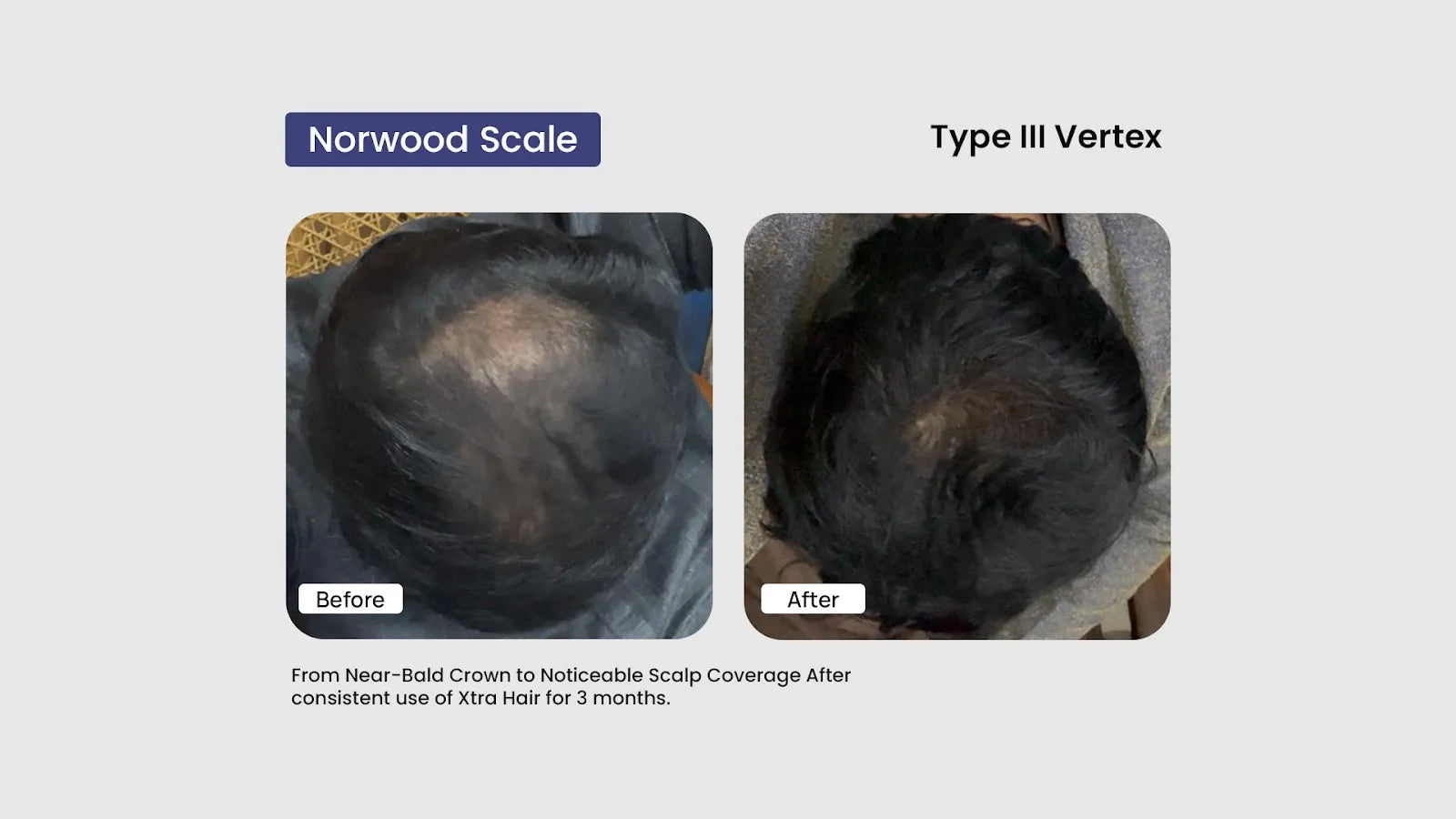 How Topical Hair Treatments Improve Hair Density