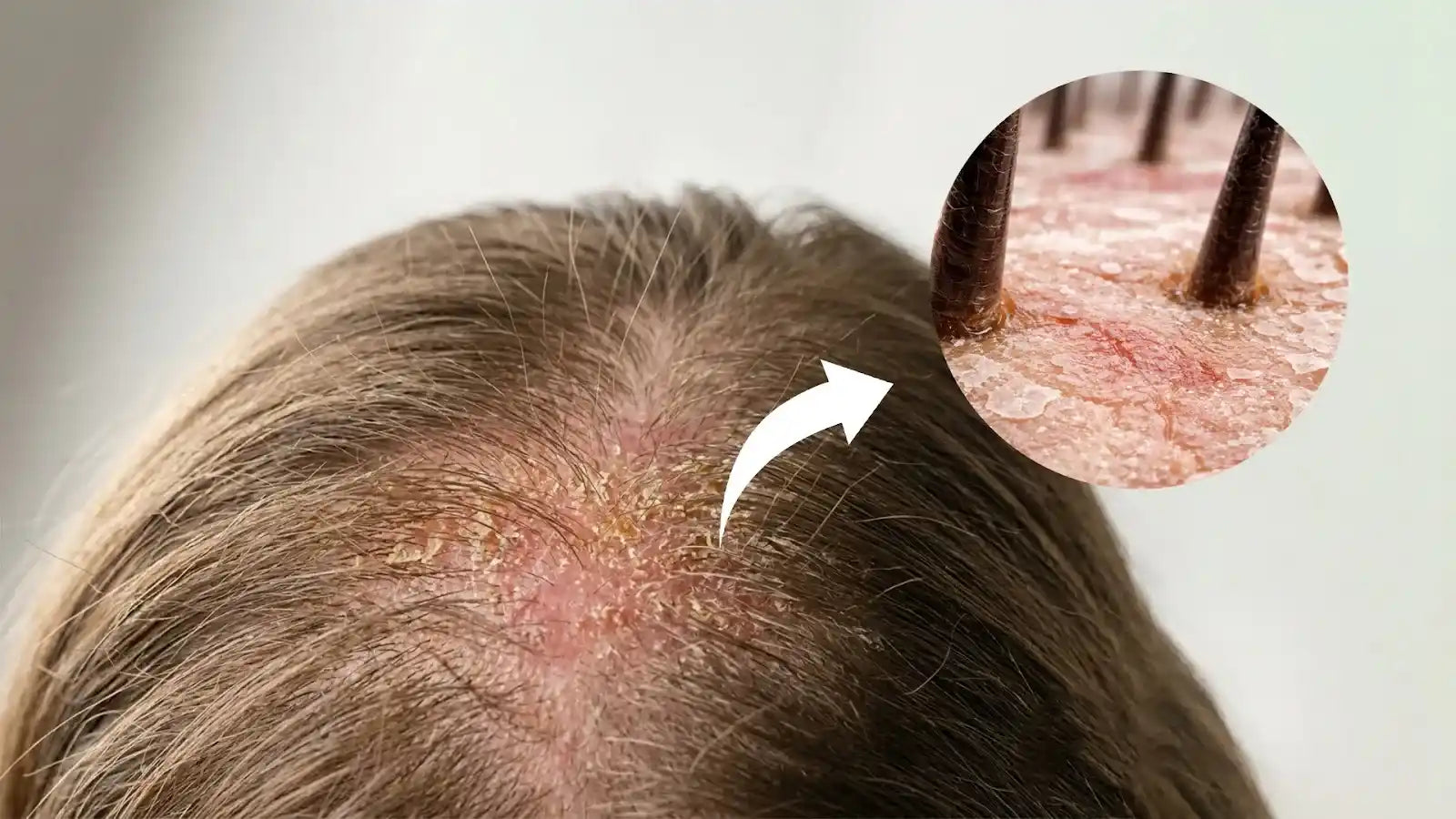 Scalp Inflammation and Hair Loss: What Is Really Happening Beneath the Surface