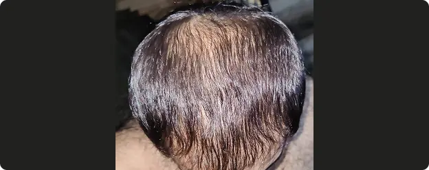 Close-up of a person's scalp with visible hair texture and color.